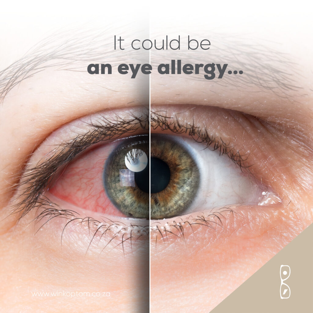 Managing eye allergies 1729 Social5 1024x1024 [object object] Blog 1729 Social5 1024x1024